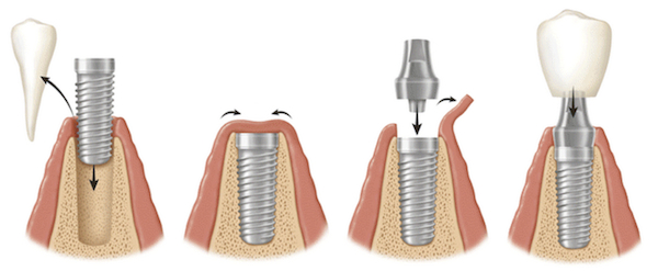 عملية زراعة الاسنان في الاردن